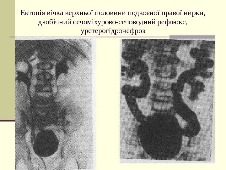   Ектопія вічка верхньої половини подвоєної правої нирки,  двобічний сечоміхурово-сечоводний рефлюкс, 